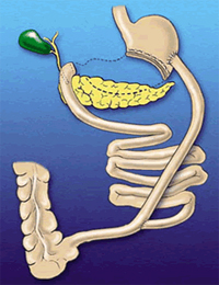 Biliopancreatic diversion