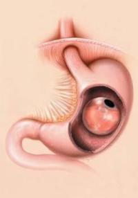 Types of Weight Loss Surgery