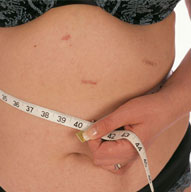 Bypass Surgery For Weight Loss