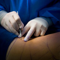 Plastic Surgery For Weight Loss