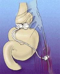 Laparoscopic obesity surgery