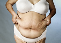 Risks of weight loss surgery